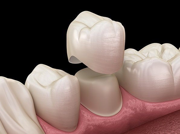 CEREC crown