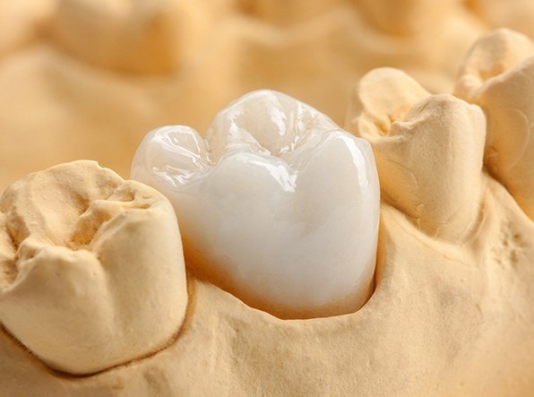 close up of dental crown