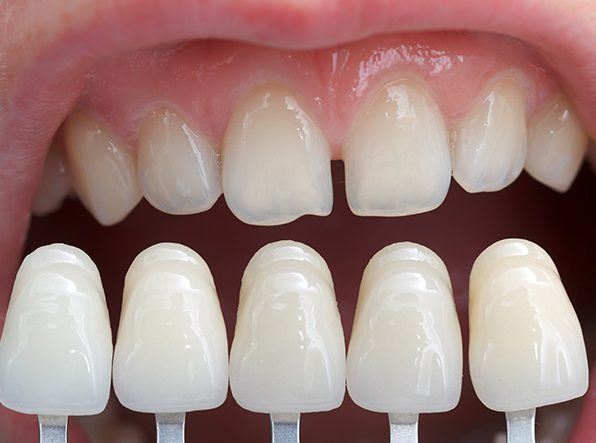 veneers in front of teeth