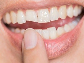 woman pointing to chipped tooth