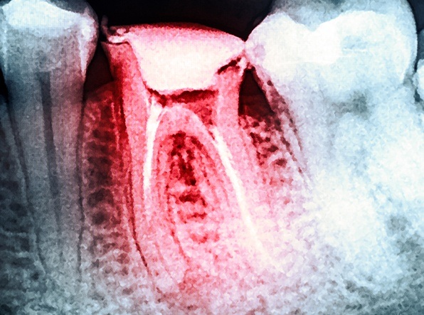 Red tooth on x-ray