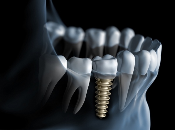 illustration of implant in jaw