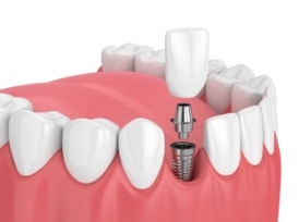 single implant example