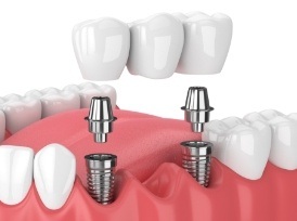 multiple implant  example