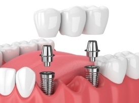 multiple implant example