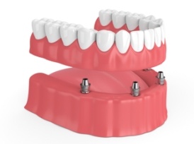implant denture example