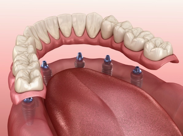 illustration of implant denture