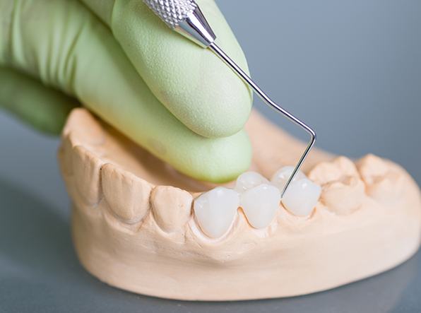 dental bridge