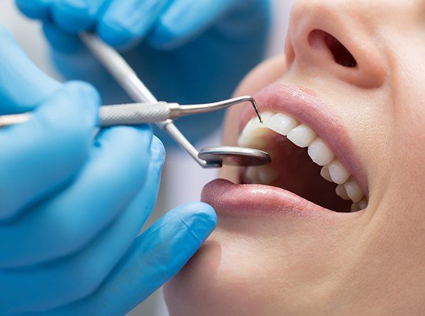 Scaling and root planing smile