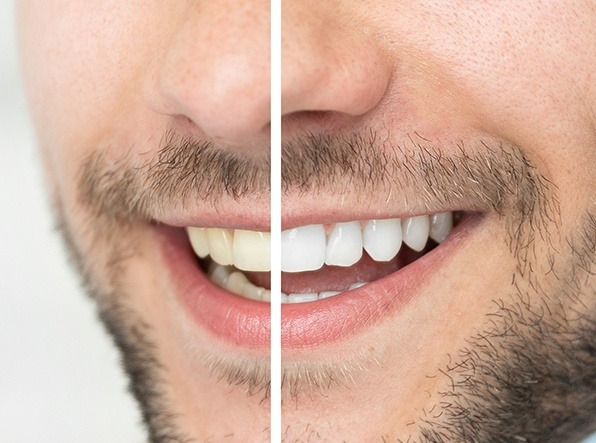 man's smile before and after teeth whitening